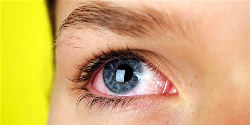 L’occhio rosso: congiuntive virale o batterica?
